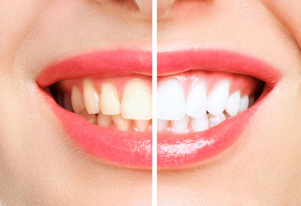 Teeth Whitening Tips