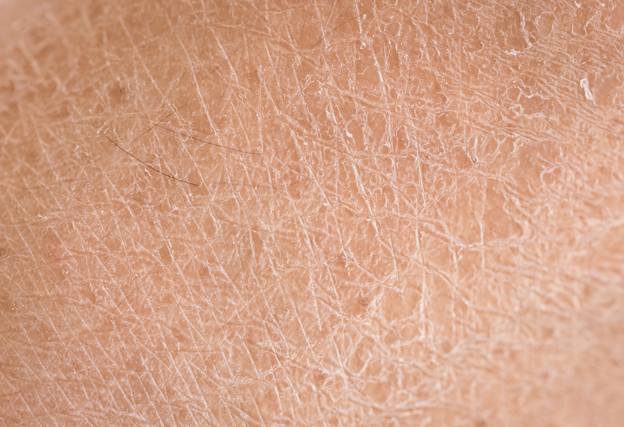 A close-up of dry skin texture, highlighting flakes and a rough surface.