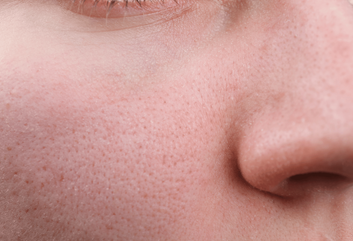 A close-up of sensitive skin texture, showcasing redness and fine pores around the nose.